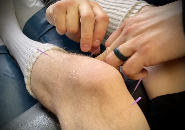 Dry Needling